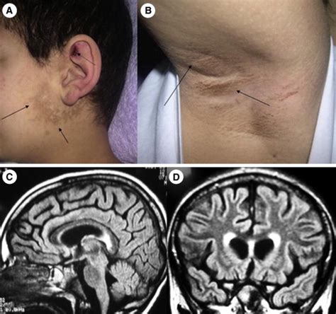 Atypical Presentation Of Neuropsychiatric Lupus With Acanthosis