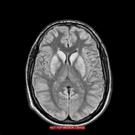 Hypoxic Ischaemic Brain Damage Radiology Case