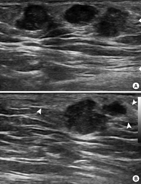 Figure 3 From Invasive Micropapillary Carcinoma In Axillary Ectopic