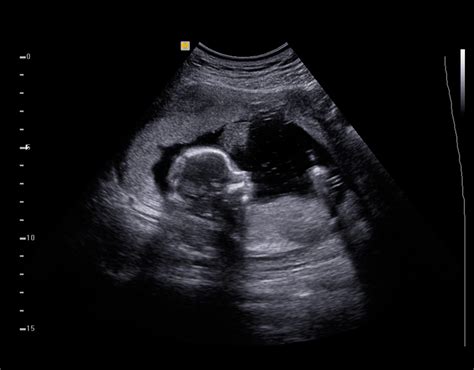 Photo gallery of baby boy ultrasound images. How does my baby develop during pregnancy? | Essential Parent