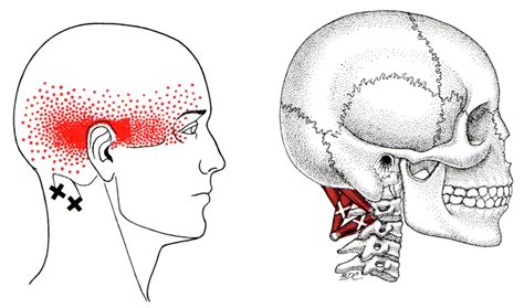 Suboccipital Group The Trigger Point And Referred Pain Guide