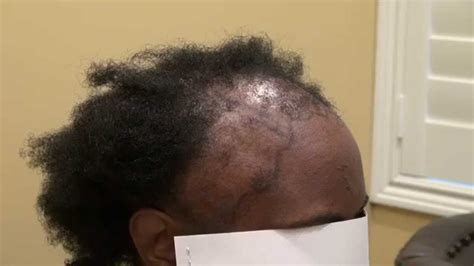 Maybe you would like to learn more about one of these? Black Woman Hair Transplant Advanced Hair Loss Pattern ...