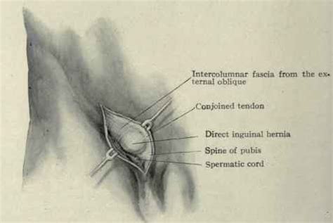 § inguinal hernia can be direct or indirect § imaging performed in. Herniae. Part 5