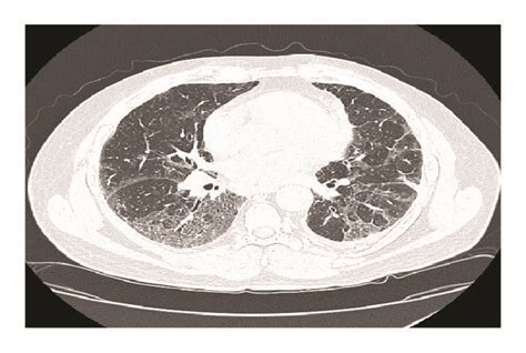 Ct High Resolution Chest Without Contrast Taken 15 Months Before Acute