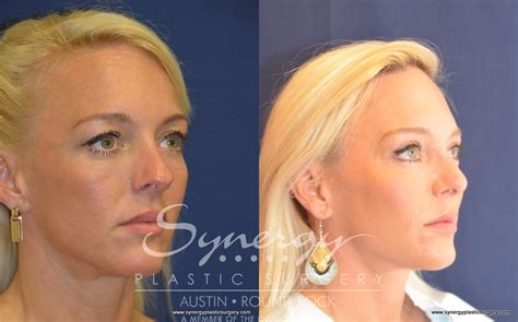 Rhinoplasty Before And After Pictures Case Round Rock TX Synergy Plastic Surgery