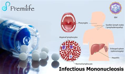 Infectious Mononucleosis Premilife Homeopathic Remedies