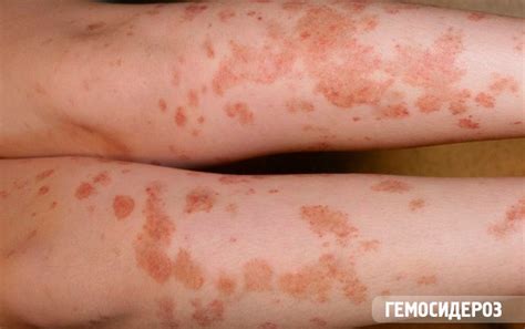 Red Spots On The Legs Causes And Pathogenesis Competently About