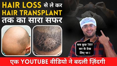 Hair Loss Hair Transplant Journey Satisfied Results Life Changing