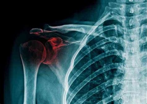 Shoulder Fracture Broken Clavicle Humerus Scapula Specialist