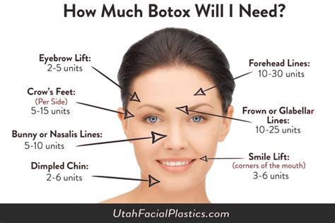 Hyaluronic acid fillers are composed of a soft naturally occurring gel that can easily be reversed and last between 12 and 24 months. How Much Botox Do I Need? | Draper and Layton, Utah