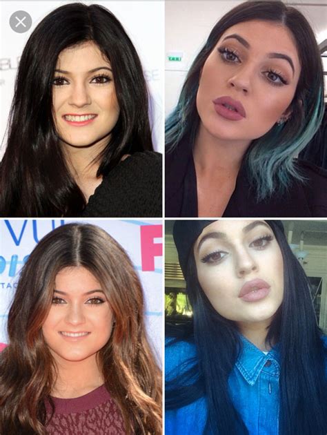 kylie jenner before and after kylie jenner lips kylie jenner lip injections lip injections