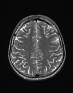 Citikolin v neuroprotekci a neuroregeneraci: Radiologické zobrazování mozku « E-learningová podpora ...