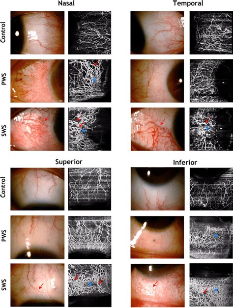 Demonstration Of Episcleral Vessels Of The Nasal Temporal Superior