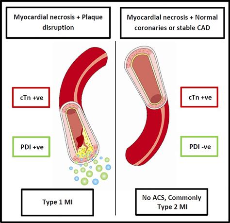 Hypothesized Role Of The Pdi In Distinguishing Type 1 And Type 2