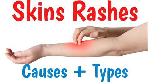 Skin Rash Causes Symptoms Types And Diagnosis Youtube