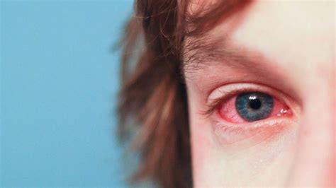 What Causes Red And Bloodshot Eyes Healthy Habits