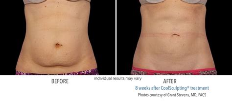 Coolsculpting Before And After Results Fat Freezing Technology