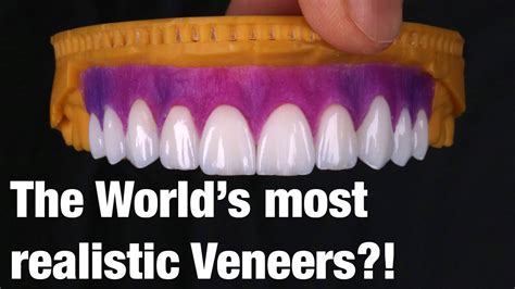 In most cases, those veneers are handmade from porcelain by a qualified dental technician. Are Da Vinci Dental's the most natural looking Veneers in ...