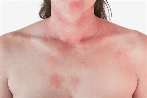 Exfoliative Dermatitis Definition Causes Treatments And More