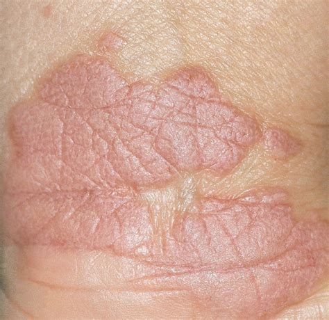 Lichen Planus Skin Rash