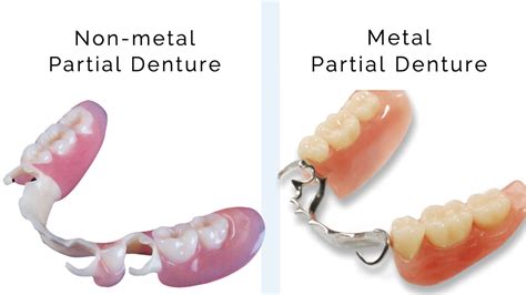 Removable Partial Dentures Everything You Need To Know 60 Off