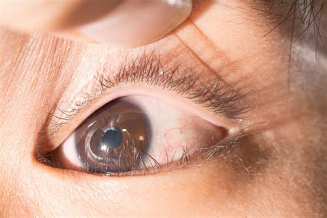 How To Treat Ingrown Eyelashes Trichiasis Causes Symptoms And More
