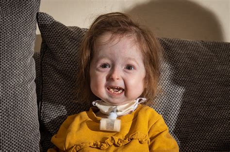 Toddler Is The Only Person With This Rare Ageing Disease