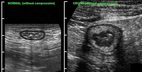 Crohns Disease Ultrasound