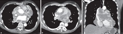 Primary Pericardial Mesothelioma Presenting As Multiple Pericardial