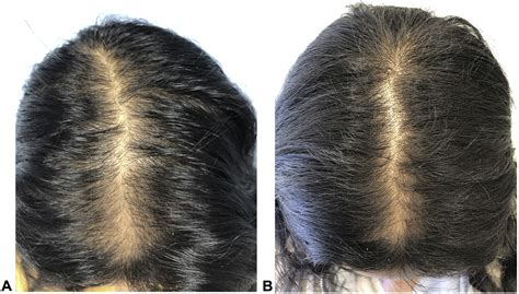 Combination Oral Minoxidil And Spironolactone For The Treatment Of