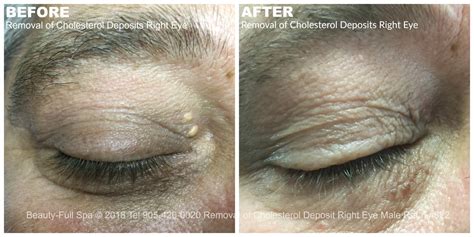 Cholesterol Deposits Removal Before And After Beauty Full Spa