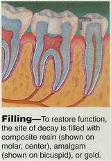 Tooth Filling Material Side Effects