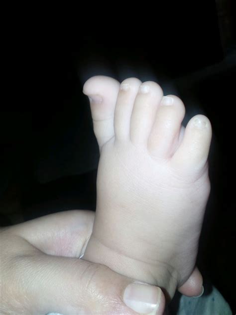 Hi All My 10 Month 13 Days Old Baby Has Swollen Feet What Is The The