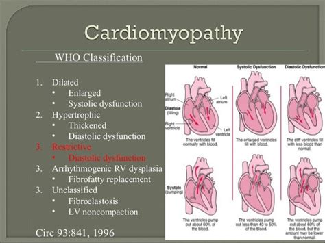 Pathophysiology Of Restrictive Cardiomyopathy