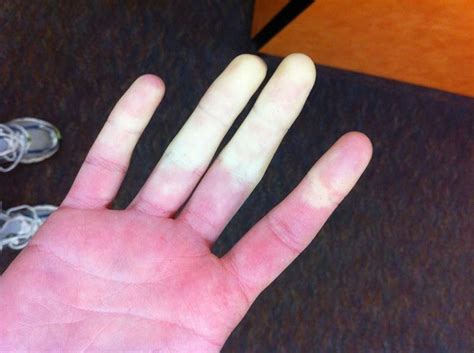 Raynauds Disease Dr Hunter Hoeper