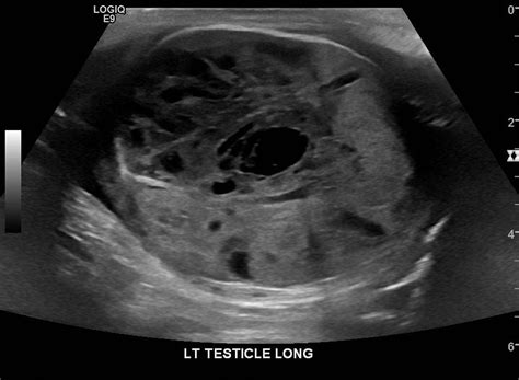 Testicular Teratoma Ultrasound