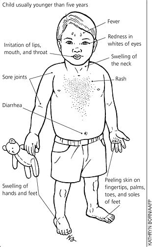 Paucis Verbis Kawasaki Disease