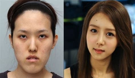 Crazy Before And After Photos Of South Korean Plastic Surgery Sick