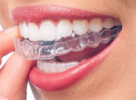 Clear Braces To Optimize Your Smile Daniel N Galaif Dds
