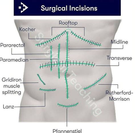 Abdominal Surgical Incisions Types