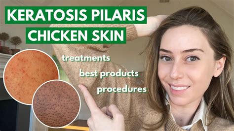 Keratosis Pilaris How To Treat Dry Bumpy Skin Aka Chicken Skin Dr