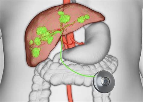 Hepatic Arterial Infusion Pump Offers New Hope To Patients With Liver