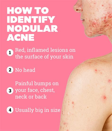 Types Of Acne Nodules