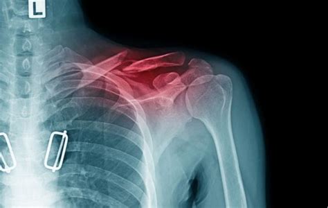 Shoulder Bursitisimpingement Treatment And Recovery Time