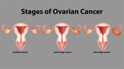 What Are The Stages Of Ovarian Cancer Everyday Health