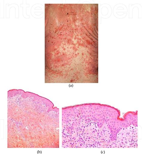 Figure 1 From 6 Severe Drug Induced Skin Reactions Clinical Pattern