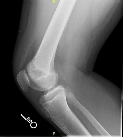 Osgood Schlatter Disease X Ray Captions Quotes