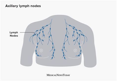 Axillary Lymph Nodes And Breast Cancer Are They Related