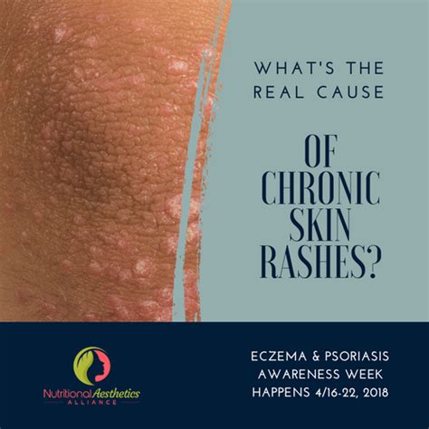 Chronic Skin Rashes What Really Causes Them