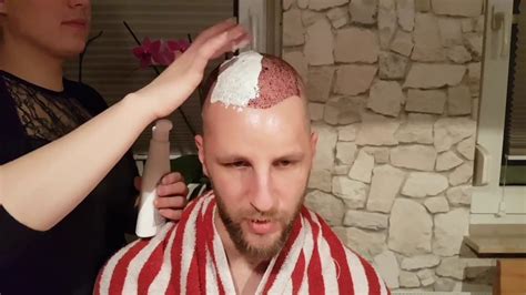 Haartransplantation T Rkei Teil Erste Haarw Sche Zuhause Youtube